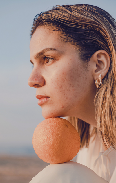 Our Guide To Treating Acne Holistically
